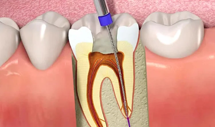 Endodoncias/Tratamiento de conductos (no molares)